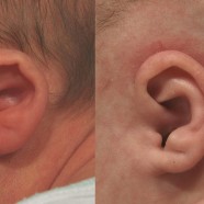 Constricted ear treated with ear molding