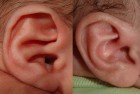 Conchal crus treated with ear molding