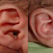 Conchal crus treated with ear molding