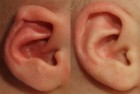 Constricted ear and lidding treated with ear molding