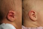 Constricted ear and lidding treated with ear molding