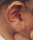Prominent/Cup Ear