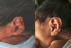 Spock ear and loss of anti-helical fold treated with ear molding