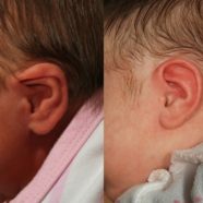 Severe ear lidding treated with ear molding