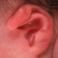 Lidding/Lop Ear