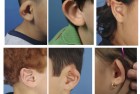 Uncorrected Ear Deformities