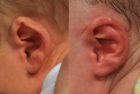 Constricted ear and prominent ear treated with ear molding