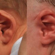 Constricted ear and prominent ear treated with ear molding