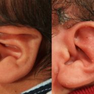 Severe lidding and vertically constricted ear treated with ear molding