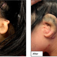 The Evolution of Microtia Surgery and Introduction of the Real Ear Reconstruction Technique