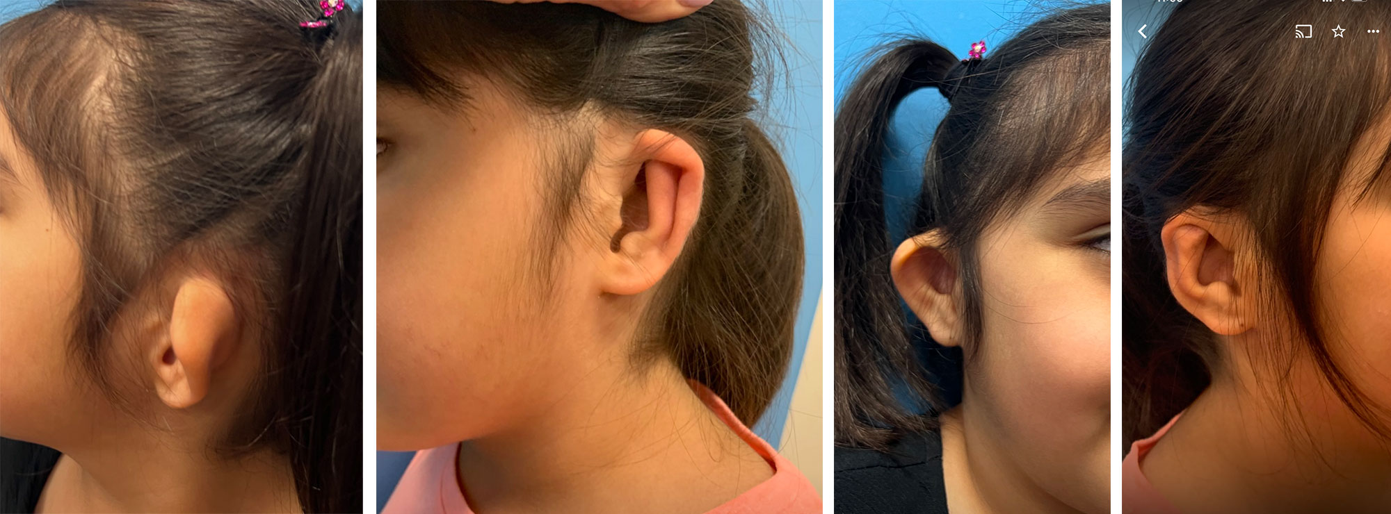 Microtia Before after